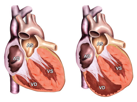 Cardiomiopatia aritmogena