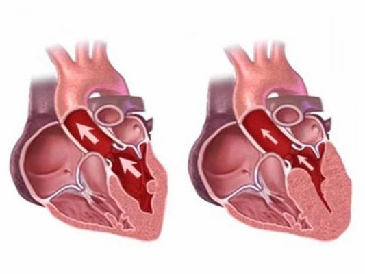 Cardiomiopatia ipertrofica