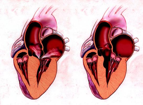 Scompenso cardiaco