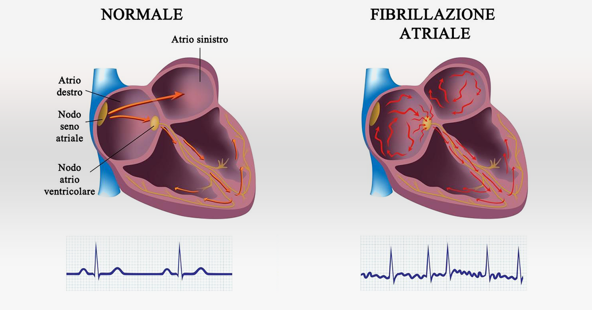 Fibrillazione atriale e morte cardiaca improvvisa: un mistero da