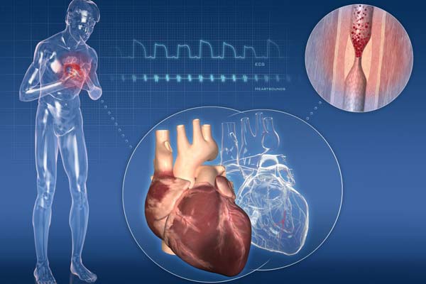 Cardiopatia ischemica ed infartuale